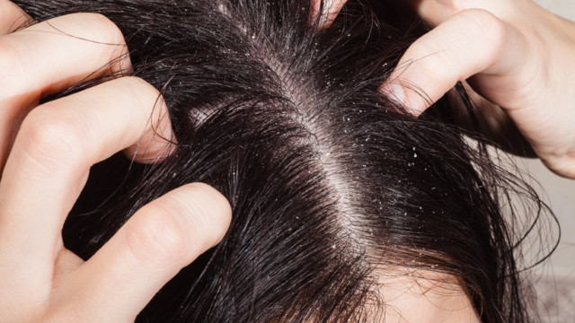 Cách trị gàu mùa đông cho chị em an toàn mà hiệu quả