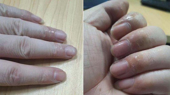 5 mẹo tẩy keo 502 dính vào tay nhanh chóng không đau
